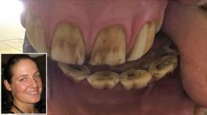 Nina Lundgren är veterinär och hästodontolog. I Gästbloggen berättar hon om en häst med käkproblem, vilket inte uppmärksammats vid besiktningen.