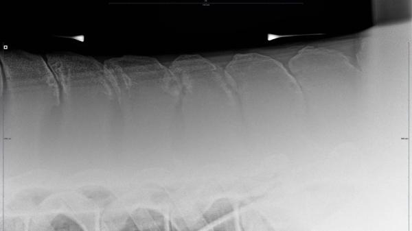 Kissing spines: Många möjligheter till förebyggande och behandling